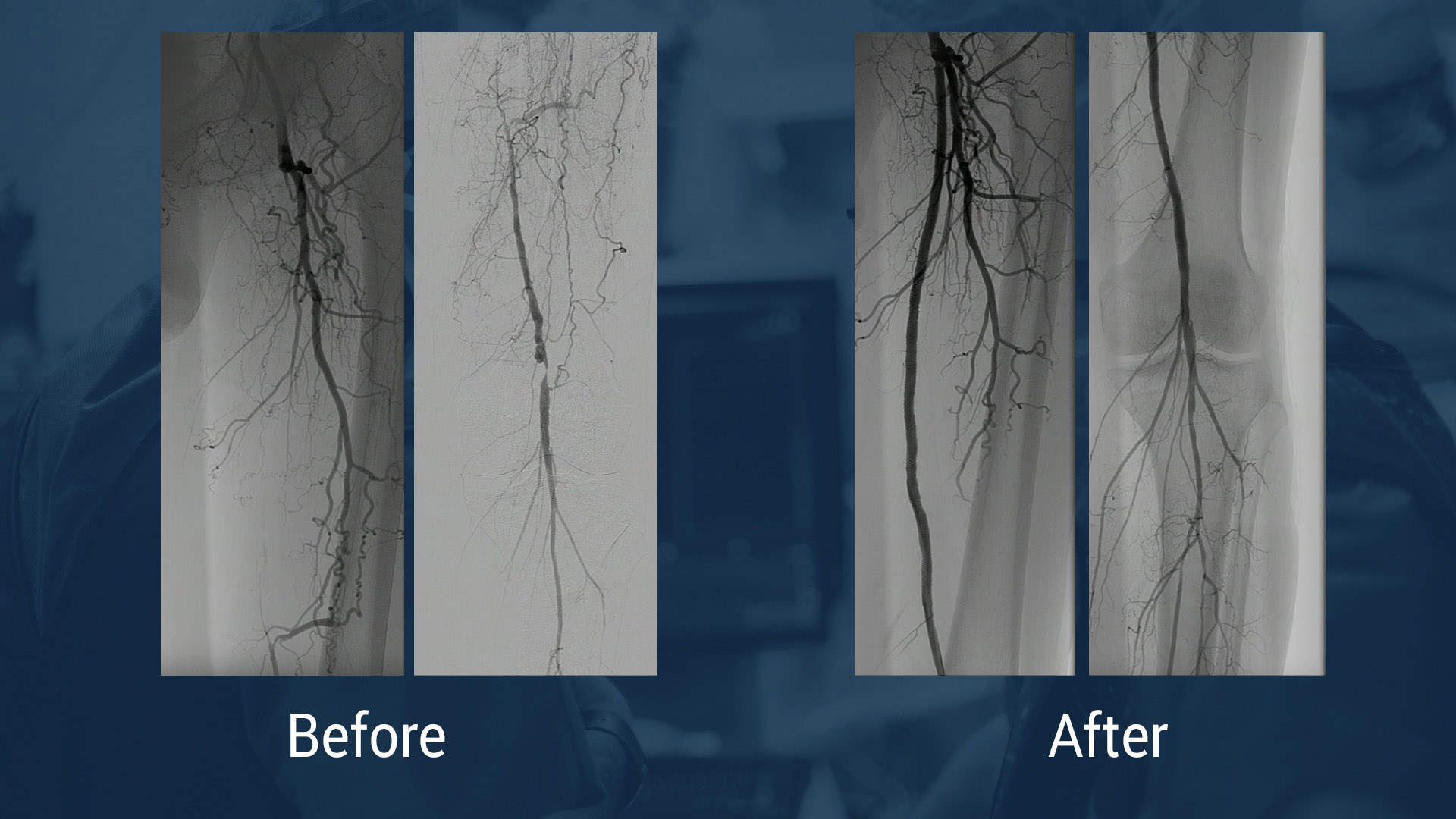 Supera Peripheral Stent System <span class="separator">/</span> <span class="labname">Abbott</span>