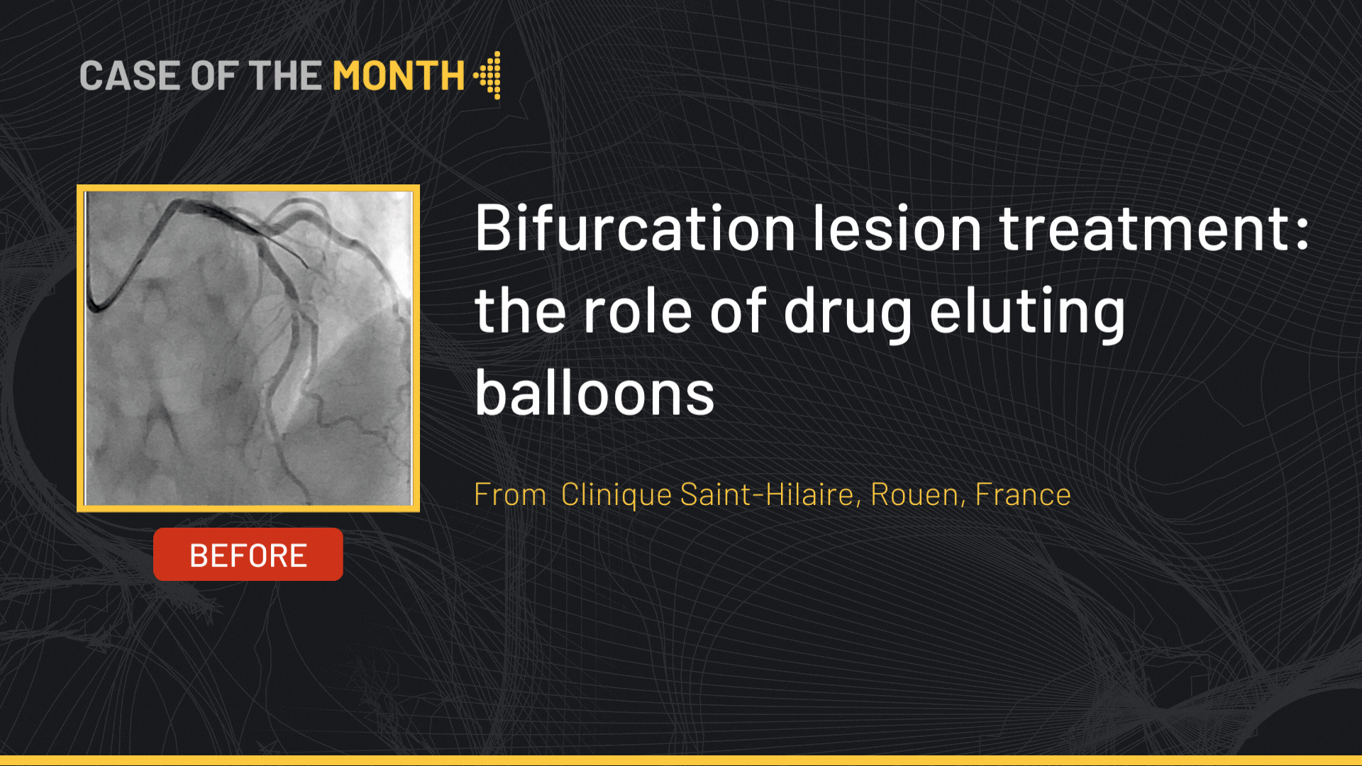 Bifurcation lesion treatment: the role of Drug Coated Balloons