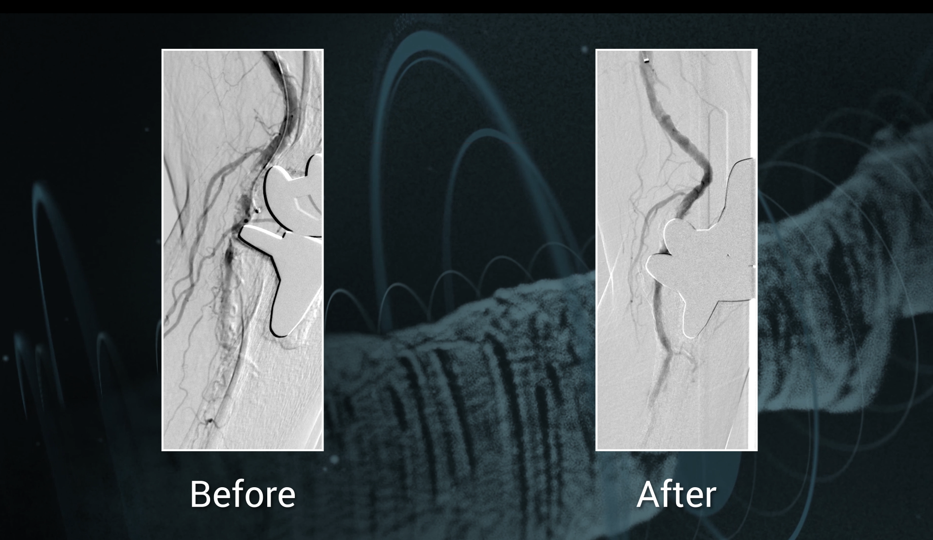 Eluvia™ <span class="separator">/</span> <span class="labname">Boston Scientific</span>