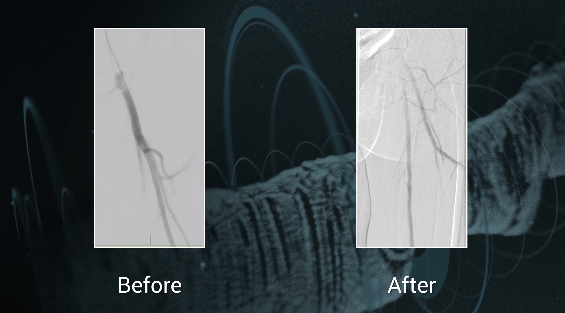 Ranger™ <span class="separator">/</span> <span class="labname">Boston Scientific</span>