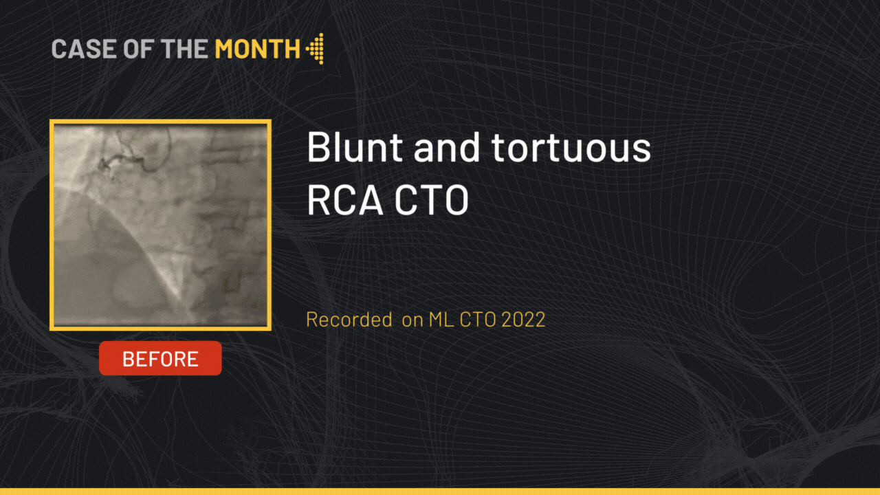 Blunt and tortuous RCA CTO