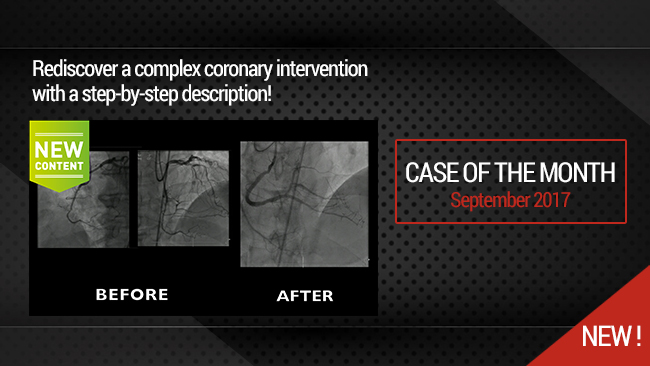 Very complex Mid RCA occlusion