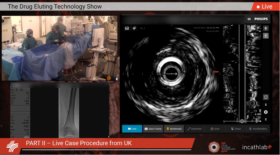 Drug-Eluting Technologies in PAD: DES and DCB vs BMS and POBA
