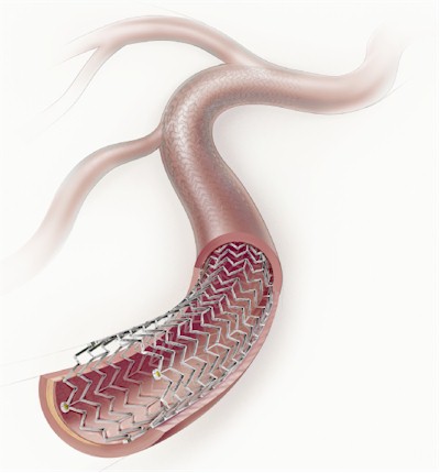 STENTS
