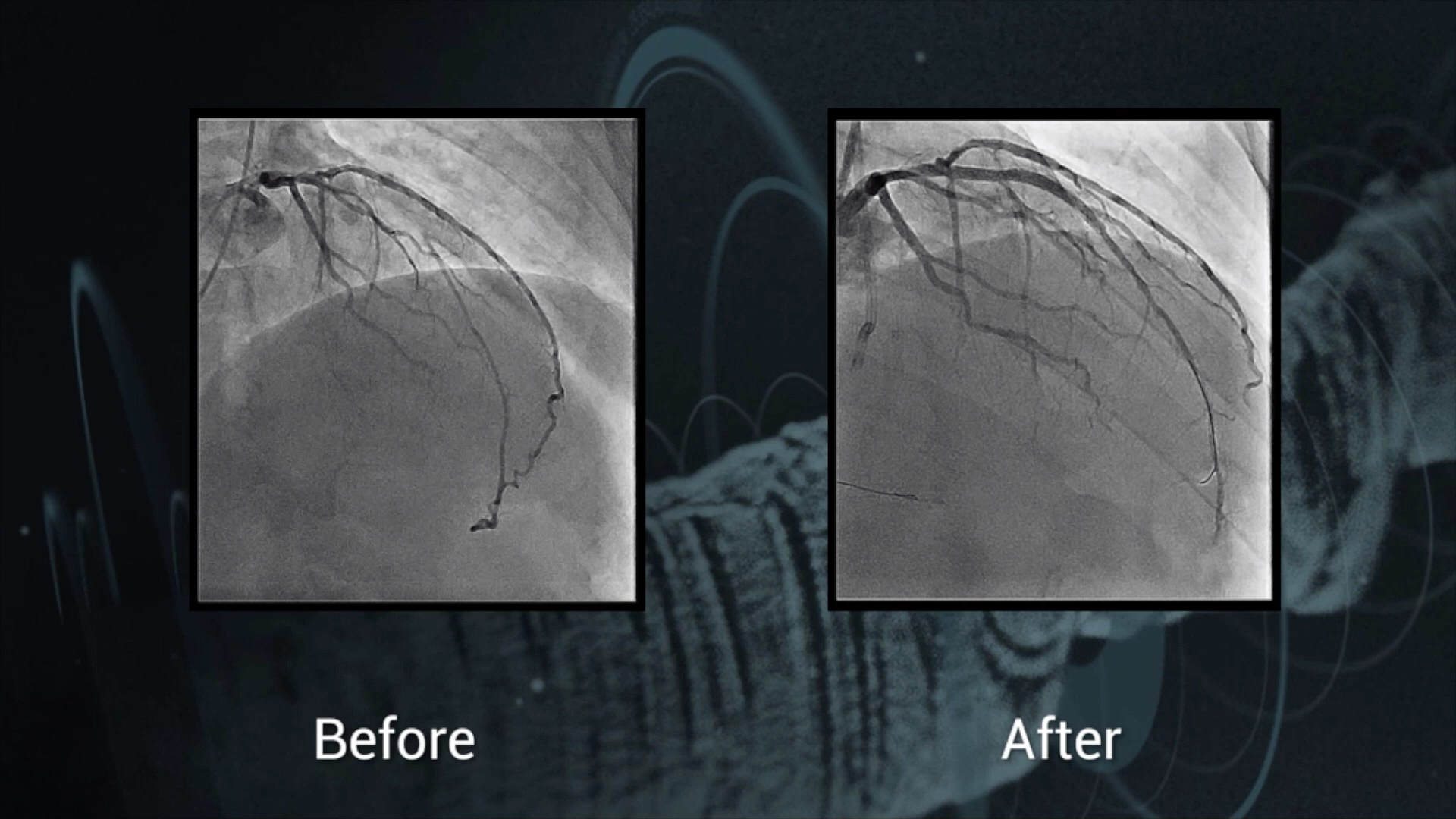 Guideliner <span class="separator">/</span> <span class="labname">Vascular Solutions</span>