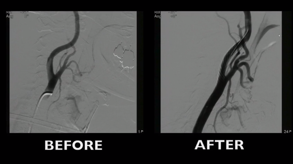 Multivascular Patient Angioplasty Left Carotid and Left Iliac stenting in one session