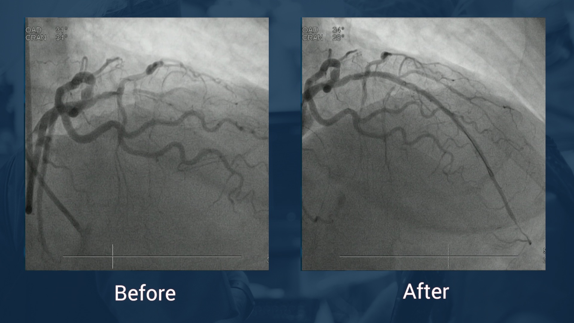 Synergy stent system <span class="separator">/</span> <span class="labname">Boston Scientific</span>