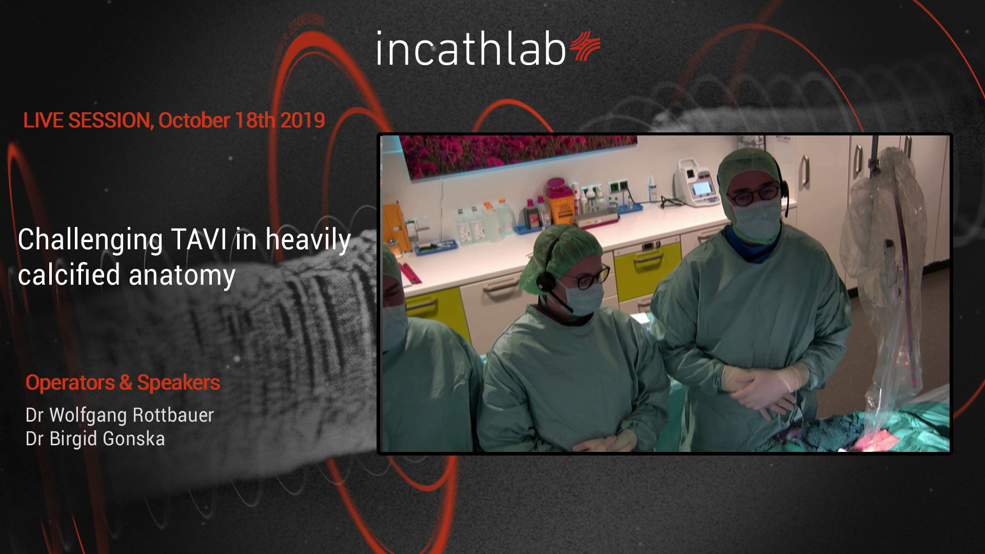 Challenging TAVI in heavily calcified anatomy