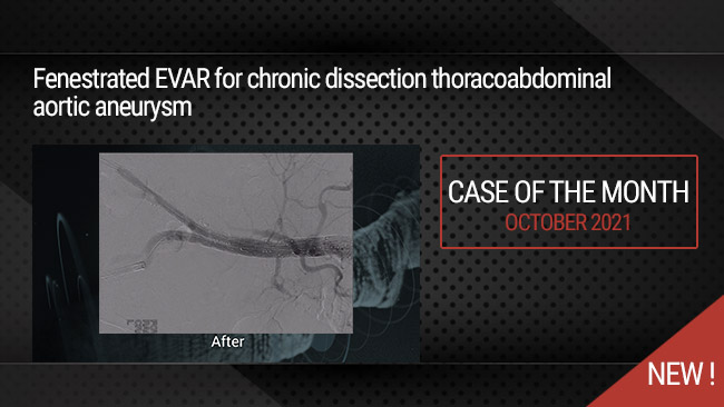 IMAC 2019 : Fenestrated EVAR for chronic dissection thoracoabdominal aortic aneurysm
