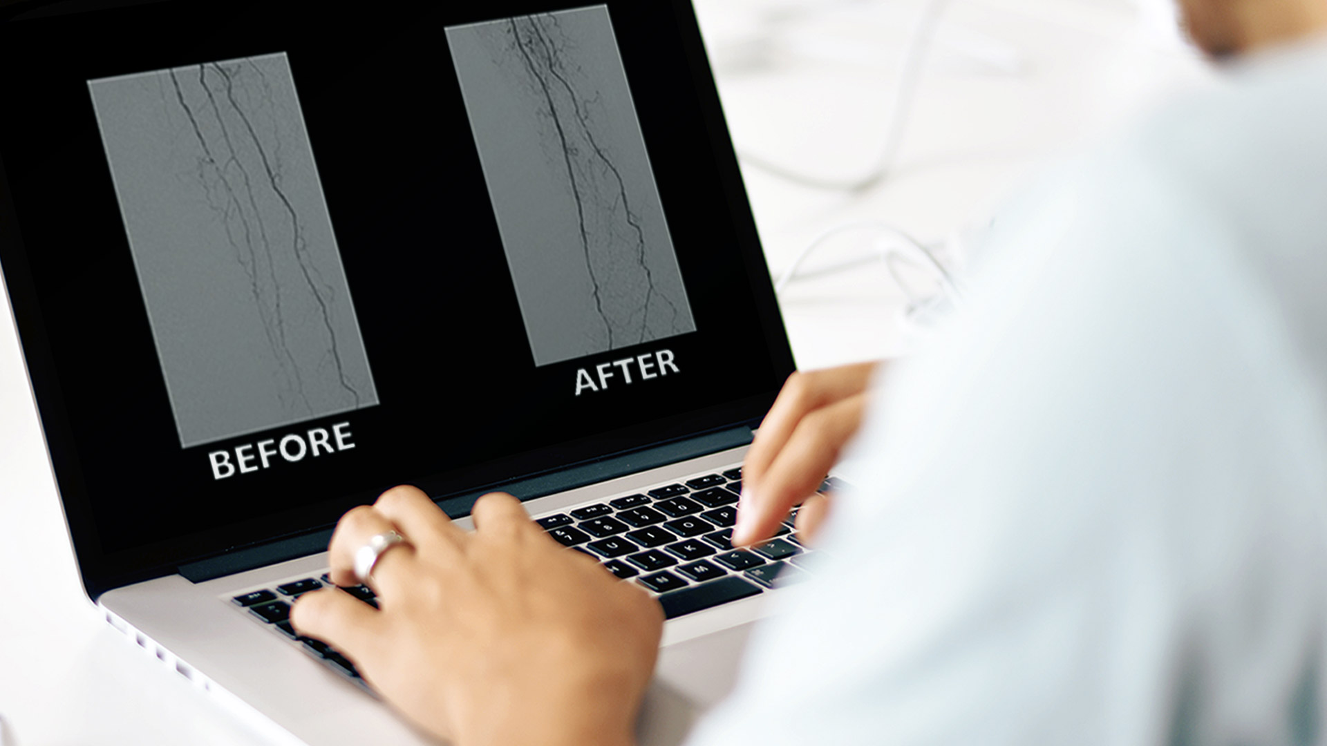 RECANALIZATION OF CALCIFIED TIBIAL ARTERIES