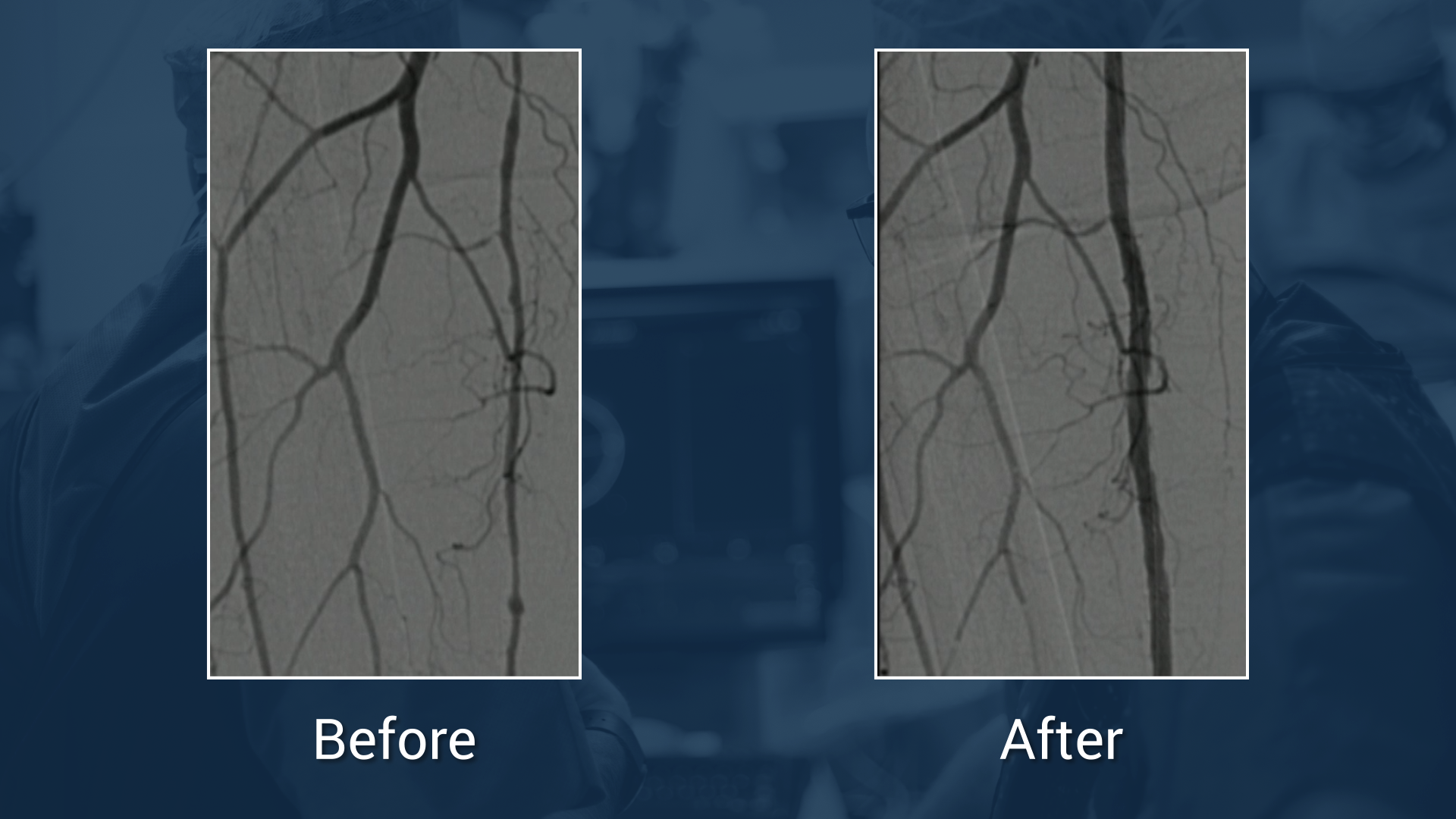 Live Case: Long SFA lesion treated according to ALARAS- and REACT strategies