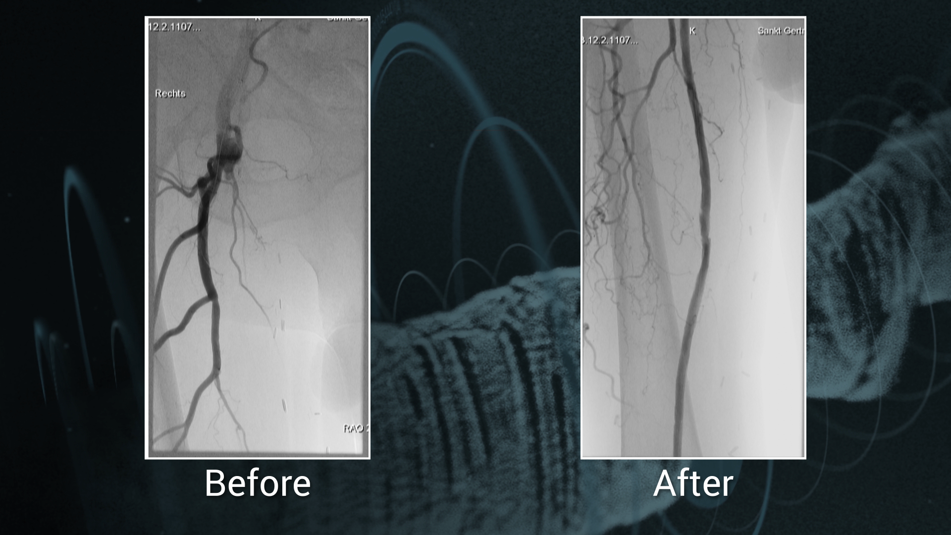 Recanalization Following REACT Strategy for a Long SFA CTO After Failed Bypass