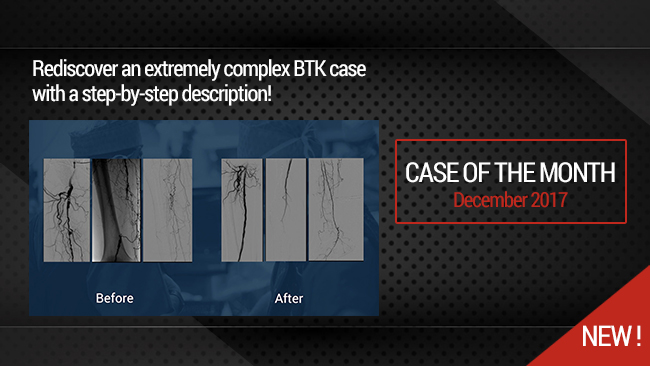 Recanalization for limb salvage