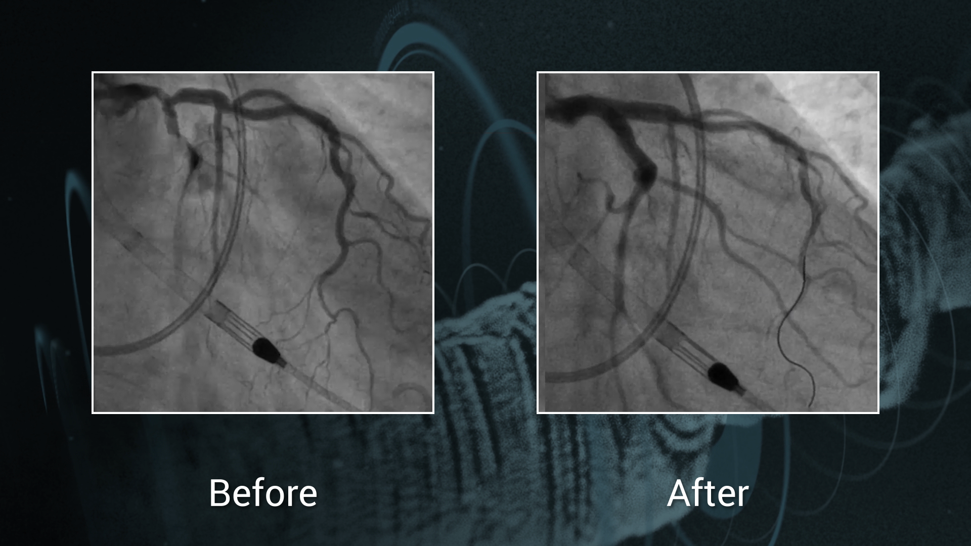 Complex PCI: severe calcified distal left main stenosis